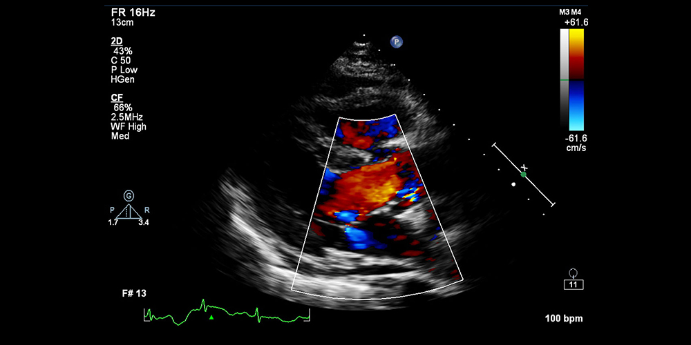 Echocardiography